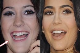 Dental Braces Before & After Islamabad