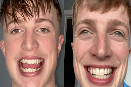 Dental Braces Before & After clinic in Islamabad
