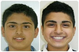 Dental Braces Before & After in Islamabad,