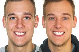 Dental Braces Before & After in Islamabad