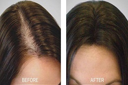 PRGF Hair Treatment before and After clinic in Islamabad