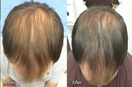 PRGF Hair Treatment before and After in Islamabad