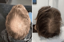 PRGF Hair Treatment before and After islamabad