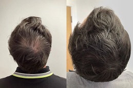 PRGF Hair Treatment before and After