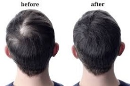 Results OF PRGF Hair Treatment clinic in Islamabad