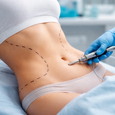 Which Areas Can Be Treated With Liposuction in Islamabad?