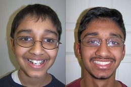 best Dental Braces Before & After in Islamabad