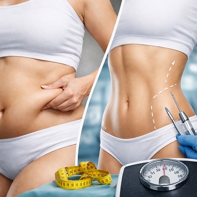 Can I Lose 10 kg With Liposuction?