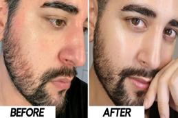 Before and After Hyaluronic acid in Islamabad