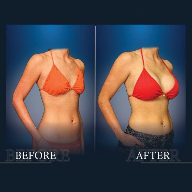 Breast Augmentation with Breast Implants Before & After clinic Islamabad
