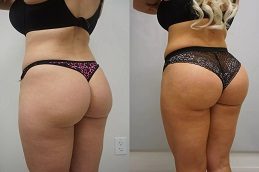 Buttock lift Before & After Islamabad,