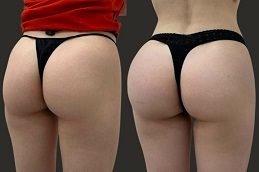 Buttock lift Before & After Islamabad,