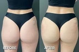 Buttock lift Before & After clinic Islamabad,