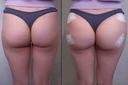 Buttock lift Before & After clinic Islamabad,