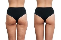 Buttock lift Before & After clinic in Islamabad,