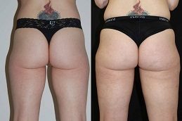 Buttock lift Before & After in Islamabad,