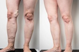 Calf Reduction before & After Islamabad,