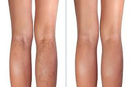 Calf Reduction before & After clinic Islamabad,,