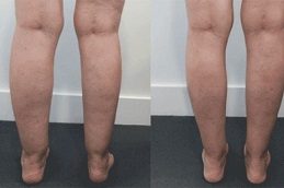 Calf Reduction before & After clinic Islamabad