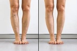 Calf Reduction before & After clinic in Islamabad,,