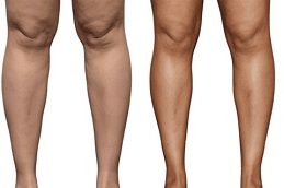 Calf Reduction before & After clinic