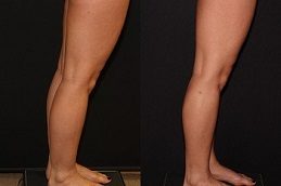 Calf Reduction before & After in Islamabad