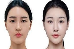 Forehead Lift Before & After Islamabad