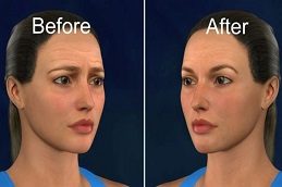 Forehead Lift Before & After clinic Islamabad