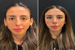 Forehead Lift Before & After clinic in Islamabad