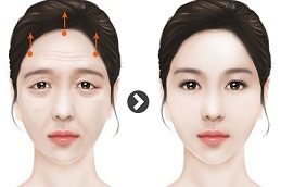 Forehead Lift Before & After clinic