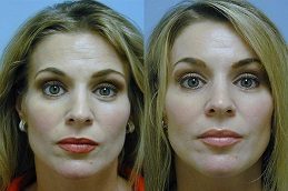 Forehead Lift Before & After in Islamabad