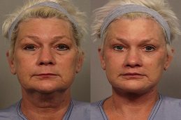 Forehead Lift Before & After