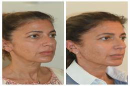 Hyaluronic acid in Islamabad Result 