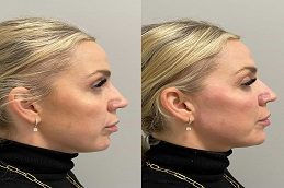 Liquid Facelift Before and After Islamabad
