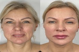 Liquid Facelift Before and After clinic Islamabad