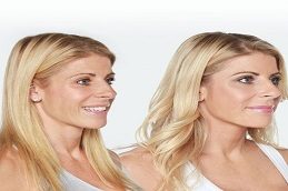 Liquid Facelift Before and After clinic in Islamabad