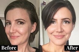 Liquid Facelift Before and After clinic