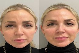 Liquid Facelift Before and After in Islamabad