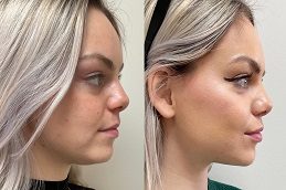 Liquid Facelift Before and After