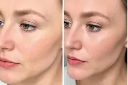 PDRN Salmon DNA Injection Before & After Islamabad