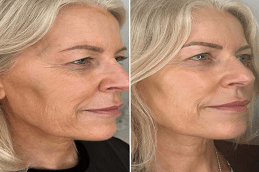 PDRN Salmon DNA Injection Before & After clinic in islamabad