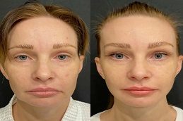 PDRN Salmon DNA Injection Before & After