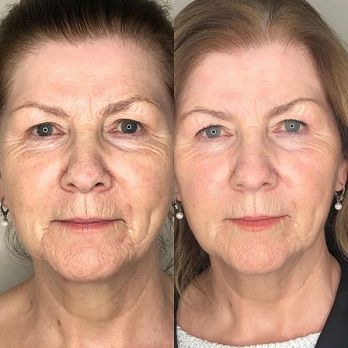 Profhilo Treatment in Before & After in islamabad