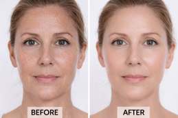 Hyaluronic acid after islamabad treatment 