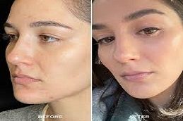 Aquagold Fine Touch Treatment Before & After Islamabad