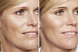 Aquagold Fine Touch Treatment Before & After