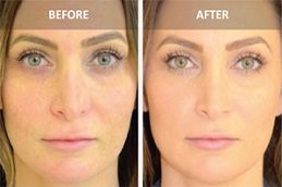 Aquagold Fine Touch Treatment Before and After islamabad,