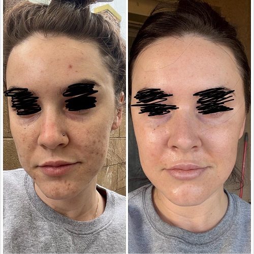 Chemical Peels Before and After Islamabad