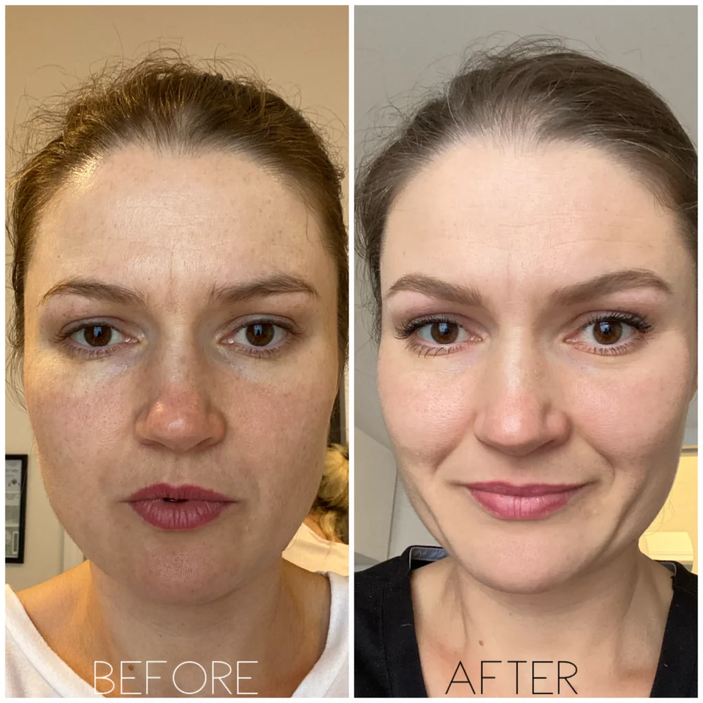 Chemical Peels Before and After clinic in Islamabad