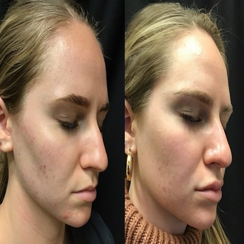 Chemical Peels Before and After